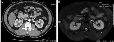 Metanephric stromal tumor with BRAF V600E mutation in an adult patient: Case report and literature review